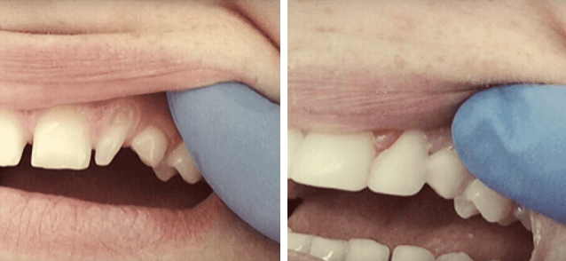 композитная реставрация зубов